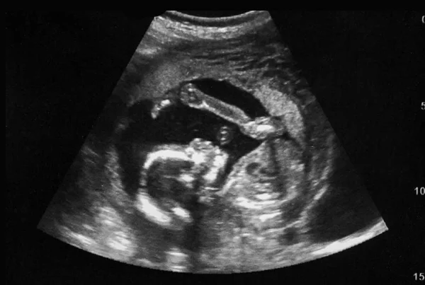Confirmation of Pregnancy