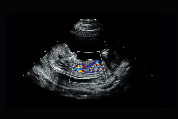 Fetal ECHO