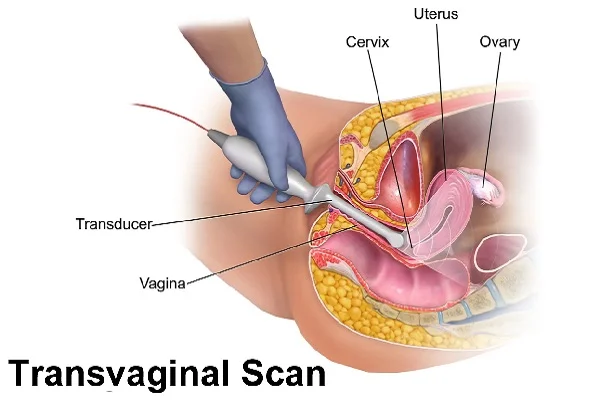Transvaginal USG